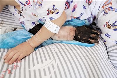 男童被毒蛇咬傷 母親用菜刀放血險致他右手殘廢
